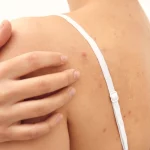 Прищі на спині та декольте – що робити? Рекомендована косметика