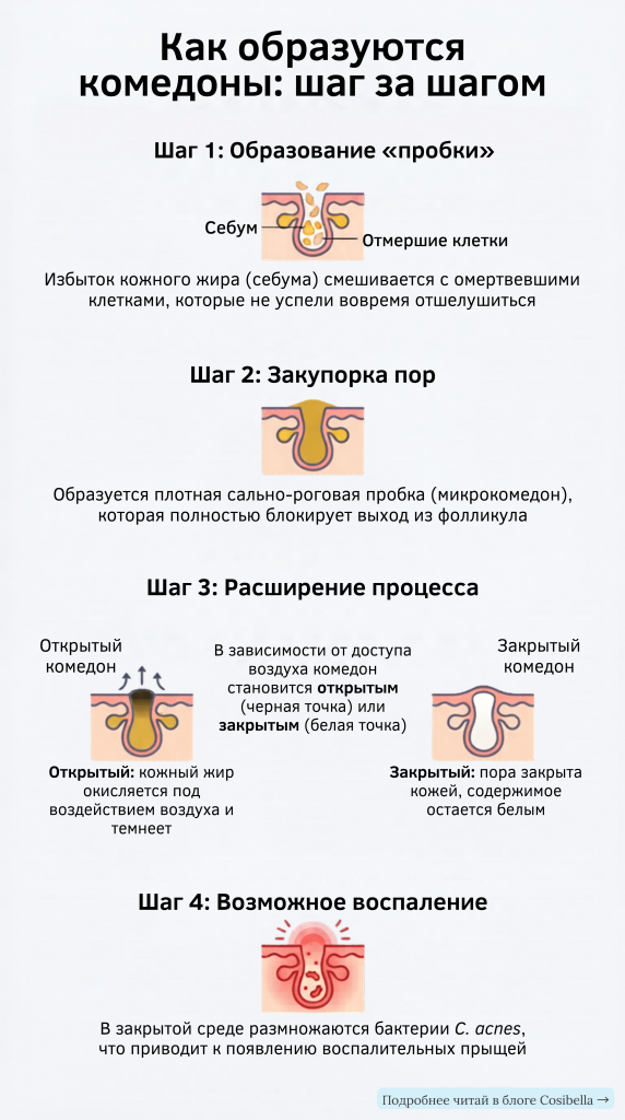 Закрытые и открытые комедоны — визуальная схема образования
