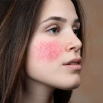 Догляд за шкірою з куперозом: покрокова інструкція від косметолога