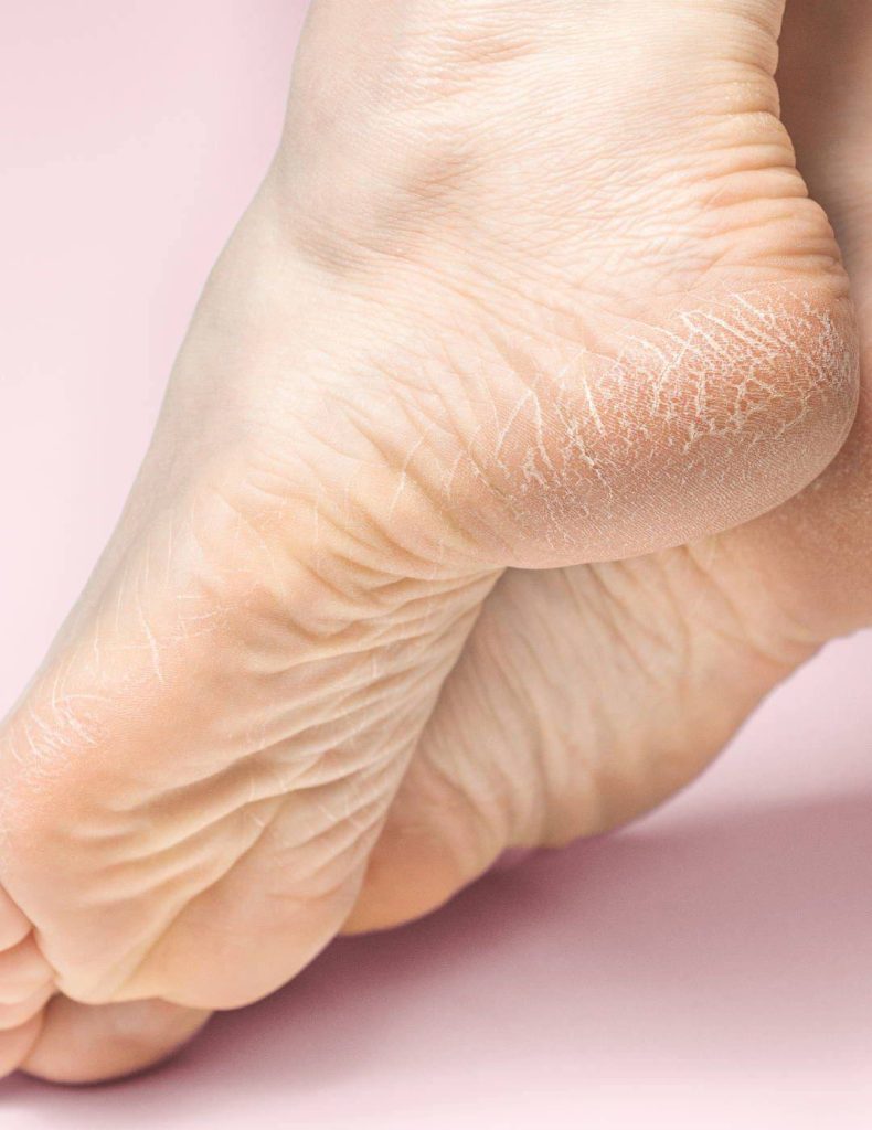 Сухі та шорсткі стопи