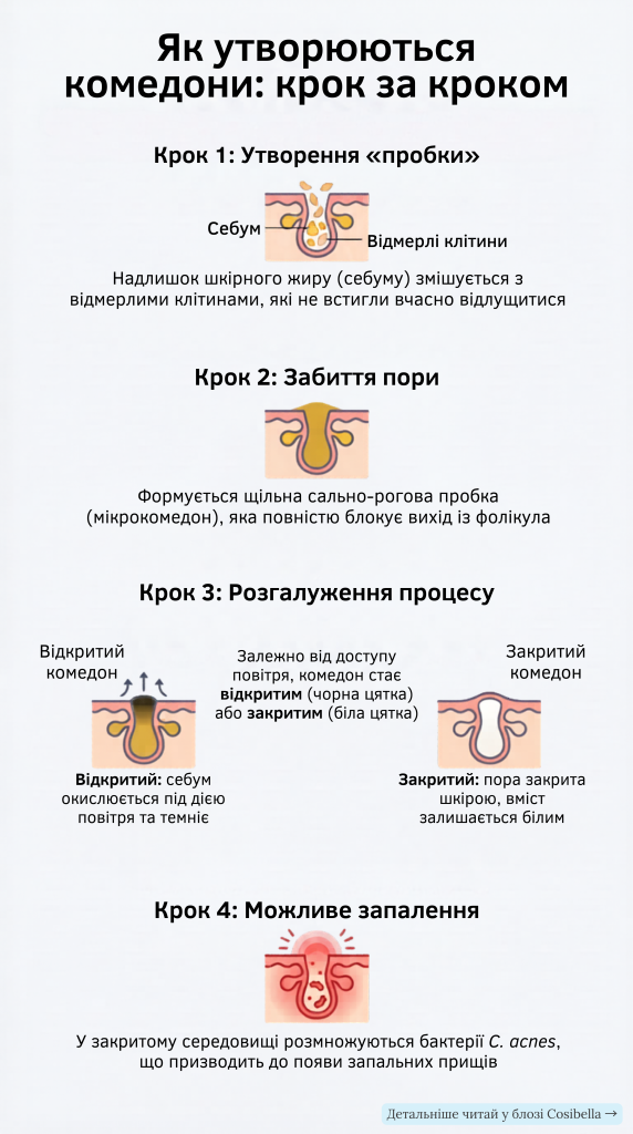 Закриті і відкриті комедони - візуальна схема утворення