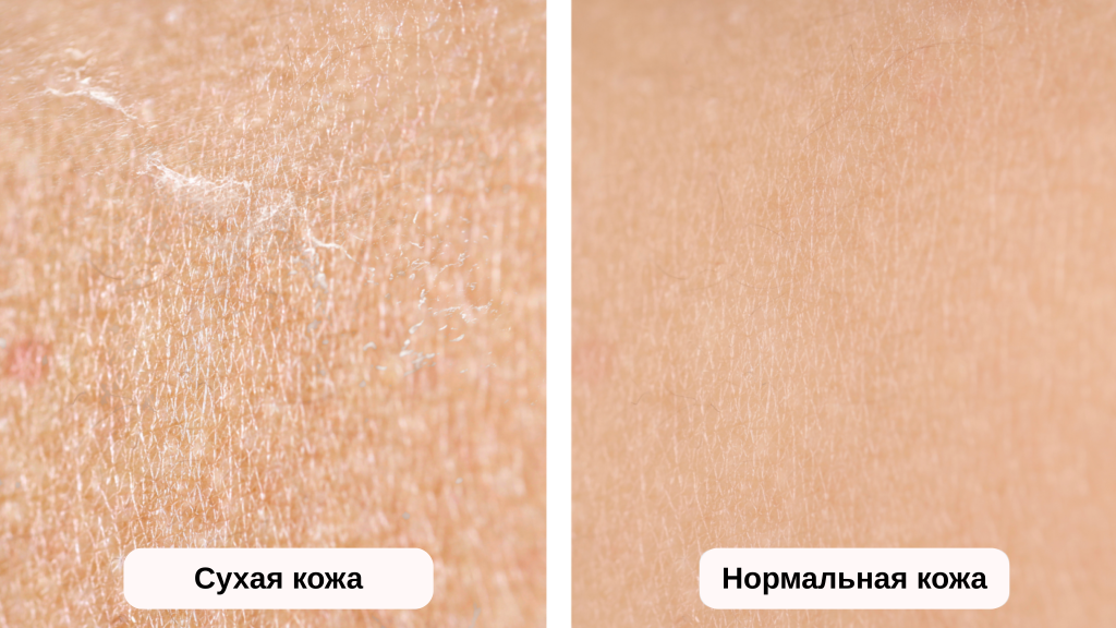 Нормальная vs сухая кожа пример