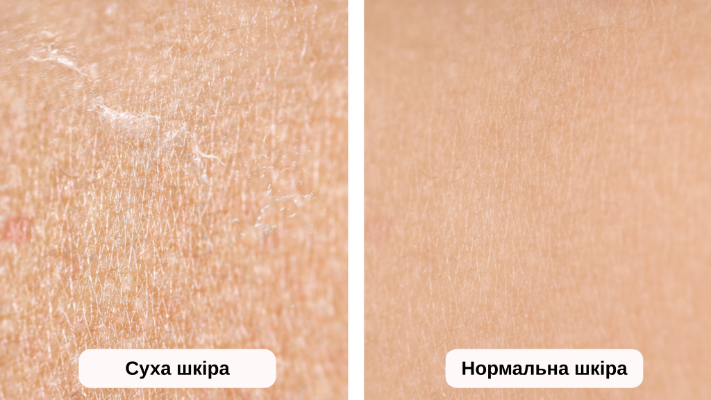 Порівняння: суха vs нормальна шкіра