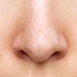 Як позбутися чорних цяток в домашніх умовах? – твоя інструкція для ідеальної шкіри