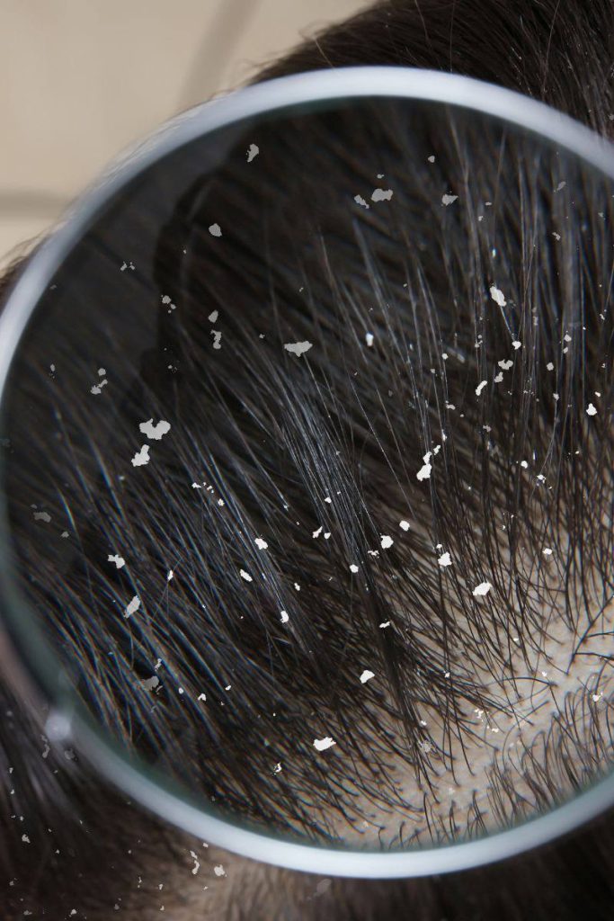 Перхоть на волосах