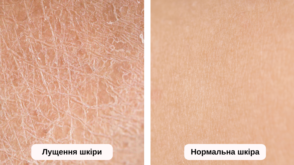 Порівняння: лущення шкіри та нормальна шкіра