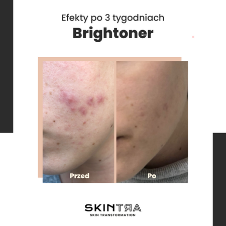 SkinTra - Brightoner - Кислотный тоник в концентрации 9% для использования круглый год - 100ml